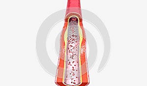 Stent insertion into artery narrowed from plaque