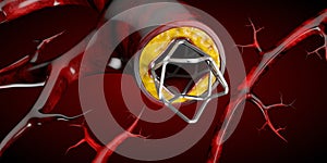 Stent medical implant concept as a heart disease treatment symbol 3D illustration.