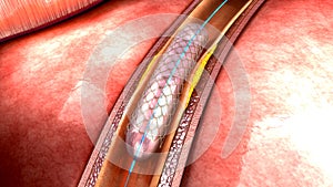 Stent