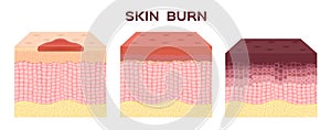 Step of burn . Normal to serious burn skin . vector and icon