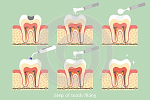 Step of caries to tooth amalgam filling with dental tools