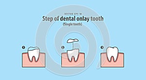 Step of dental onlay tooth Single tooth illustration vector on