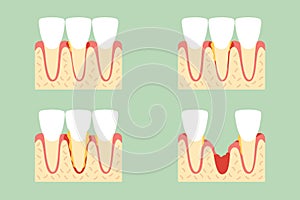 Step of periodontal disease or gingivitis of incisor tooth photo