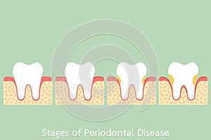 Step of periodontal disease / periodontitis / gingivitis / gum disease, dental problem photo