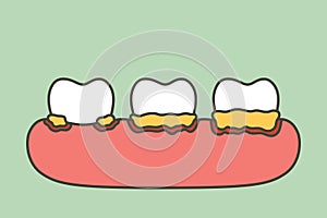 Step of periodontitis or gum disease that is inflamed and has blood - dental cartoon vector flat style