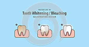 Step of single tooth Whitening-Bleaching and human gum illustration vector on blue background. Dental concept.