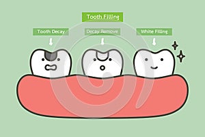 step of tooth amalgam filling by dental tools to protection decay tooth, before and after - teeth cartoon vector flat style