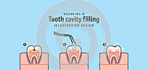 Step of tooth cavity filling cross-section structure inside toot photo