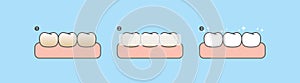 Step of whitening teeth by teeth whitening strips. illustration vector design on blue background. Dental care concept