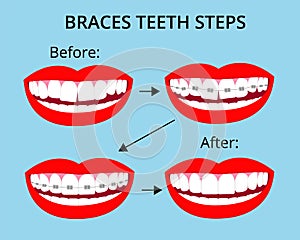 Steps of braces orthodontic treatment on smile mouth with white teeth. Before and after. Vector isolated elements. EPS10