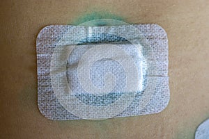 Sterile patch on abdomen covers surgical sutures treated with brilliant green