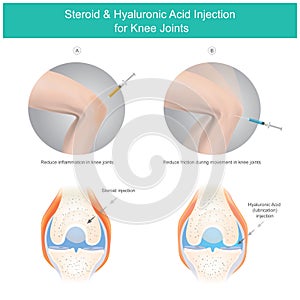 Steroid & Hyaluronic Acid Injection for Knee Joints. Illustration explain the steroid fluid and the hyaluronic acid fluid