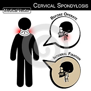 Stick man with hard collar ( Cervical spondylosis ) and bubble ( Before operate , After operate internal fixation by plate and