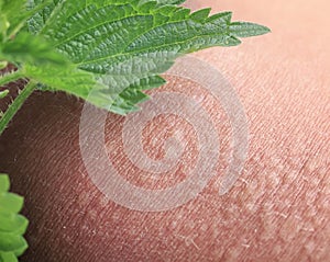 stinging nettle lying on irritated human skin covered with small wrinkles ,cracks and causes a burn with blisters