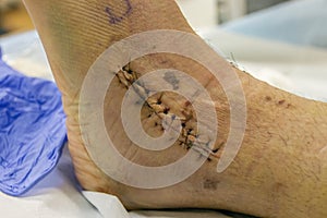 Stitches on human ankle and foot.