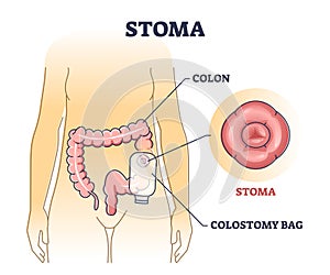 Stoma bag after colon surgery as medical patient drainage outline diagram