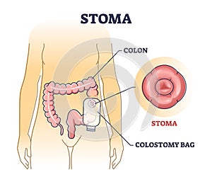 Stoma bag after colon surgery as medical patient drainage outline diagram photo