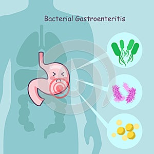 Stomach with bacterial gastroenteritis