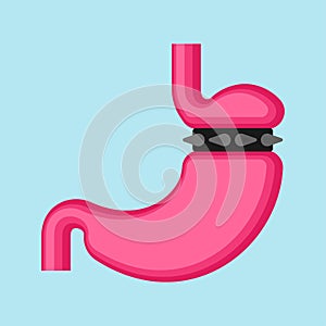 Stomach banding isolated. Adjustable Gastric Band. vector illustration