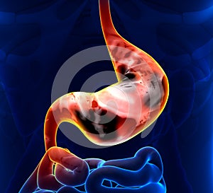 Stomach Cancer
