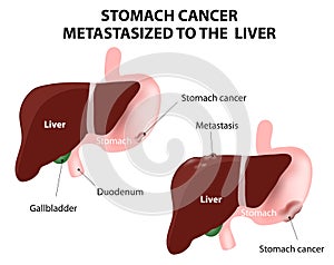 Stomach cancer Metastasized to the liver