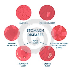 Stomach diseases detected by endoscopy medical procedure