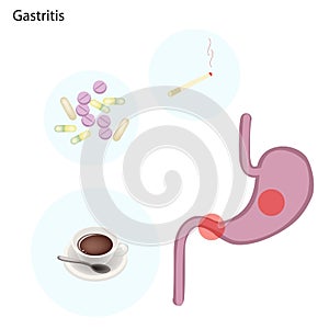 Stomach Disorder Concept on A White Background
