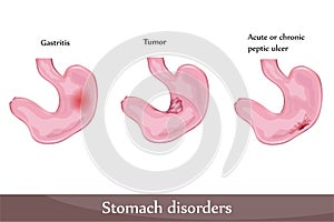 Stomach disorders photo