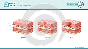 Stomach erosion and peptic ulcer