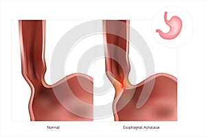 The stomach or esophagus is often referred to as simple Achalasia. The lower esophageal sphincter does not relax, causing