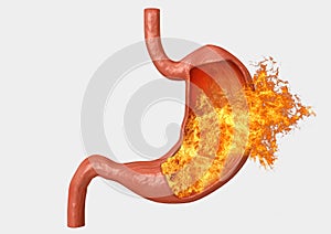 Stomach fire. excessive acidity, indigestion, stomach disease, gastric ulcer, severe abdominal pain photo