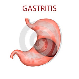 Stomach, gastritis