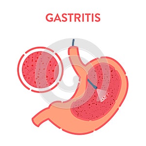 Stomach gastritis detected by endoscopy medical procedure