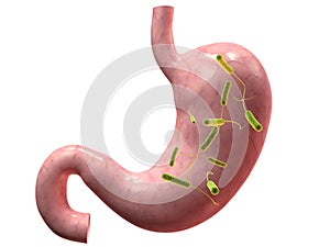 Stomach infection photo