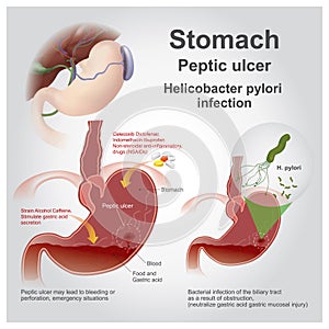 Stomach peptic ulcer. photo