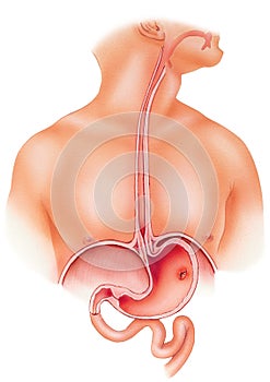 Stomach - Peptic Ulcer photo