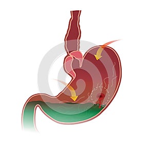 Stomach peptic ulcer. White background isolate.