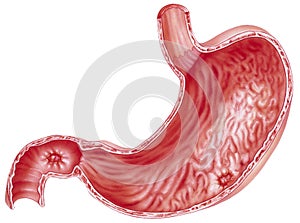 Stomach - Peptic Ulcers photo