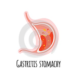 The stomach of a person with gastritis. Gastroenterology. Vector illustration in a flat style.