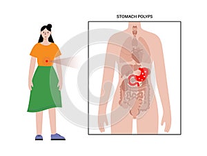 Stomach polyp disease