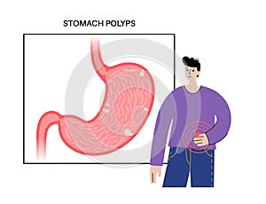 Stomach polyp disease