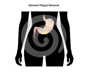 Stomach polyp removal