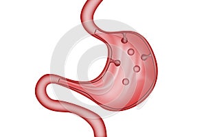 Stomach polyps of the digestive system