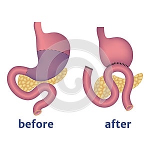 Stomach resection according to the Billroth method 2.