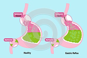 Stomach with sphincter