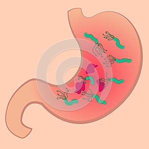 A Stomach with ucler and Helicobacter pylori