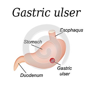 Stomach ulcer affected. Gastric ulcer. Vector photo