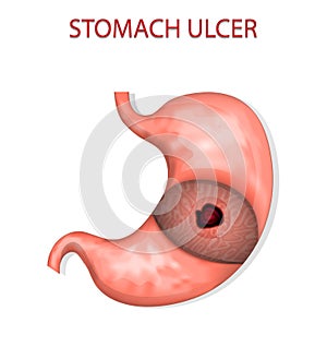 Stomach ulcer photo