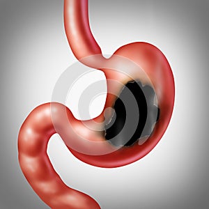 Stomach Ulcer Medical Concept photo