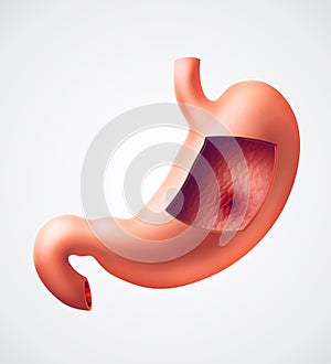 Stomach ulcer photo